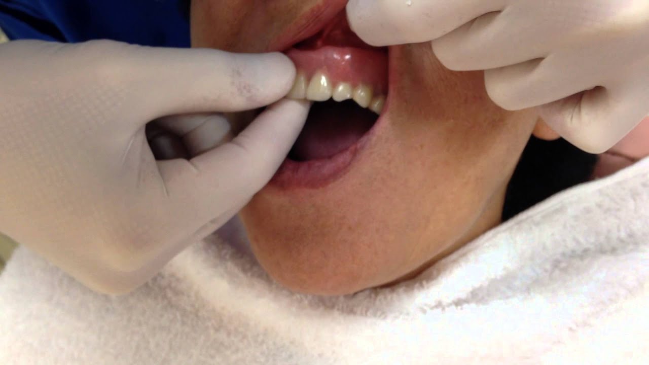 マグネットを使った義歯 入れ歯 星野歯科クリニック