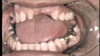 CENTRIC JAW RELATION RECORDS - PART II - FIXED PARTIAL DENTURES AND CROWNS