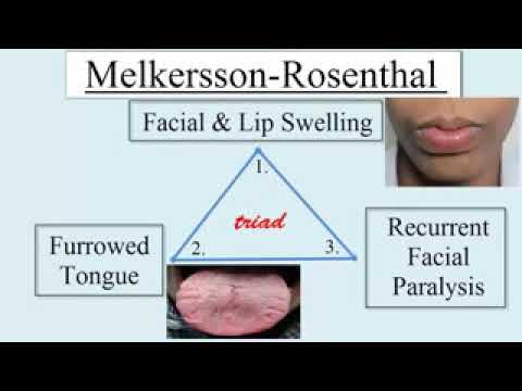 Melkersson Rosenthal Syndrome