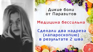 Дикие боли от Паразитов. Медицина бессильна. Сделали два надреза (лапароскопию)в результате 2 шва. Дикие боли от Паразитов. Медицина бессильна. Сделали два надреза (лапароскопию)в результате 2 шва.