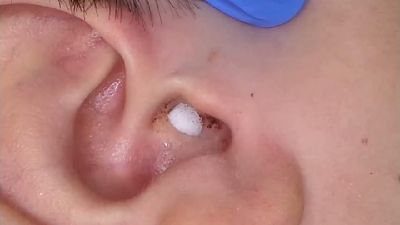 Otitis Externa YouTube