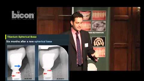 Evidencia clnica de los implantes Bicon por Dr. Ra...