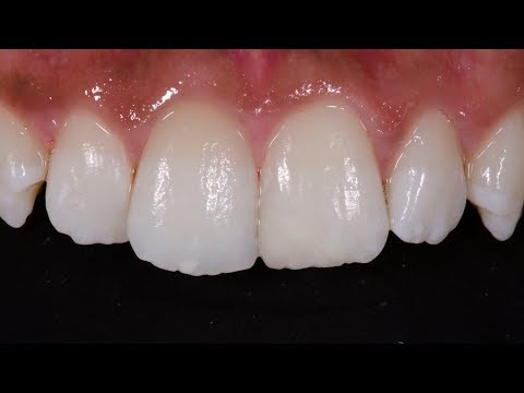 Internal Bleaching