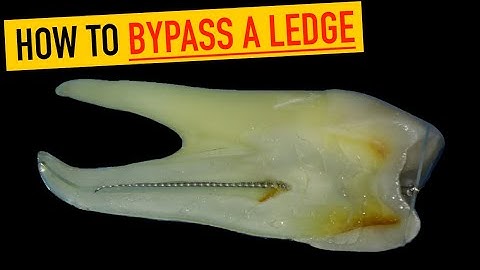 How to Fix a Ledge in Root Canal (Step-by-Step Technique)