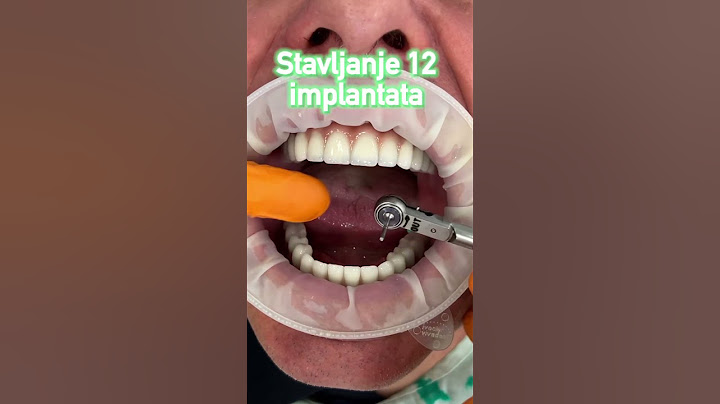 Da li znate sa cim smo izvadili pacijentu sve zube? #dentist