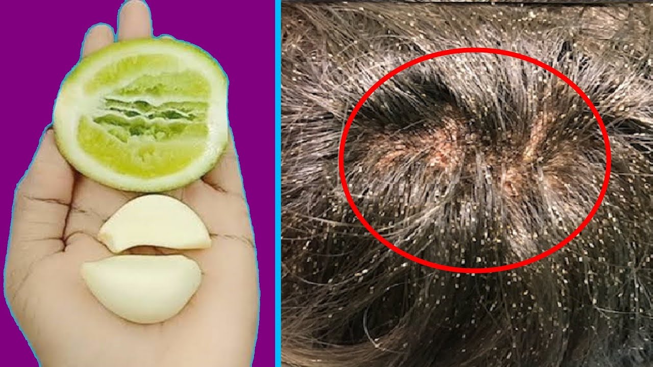 Eliminate LiceAbolish Ways To Eliminate LiceRemove Lice 100 From