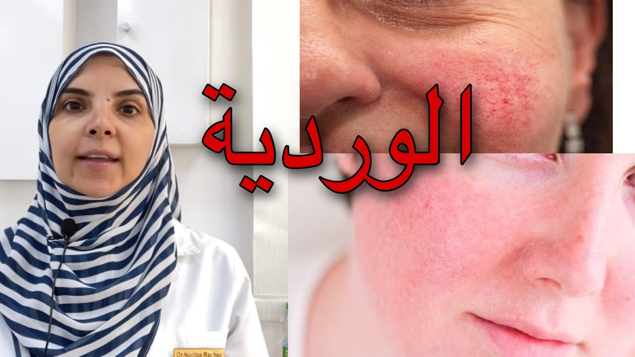 الوردية و طرق علاجها مع د.نجلاء راشد