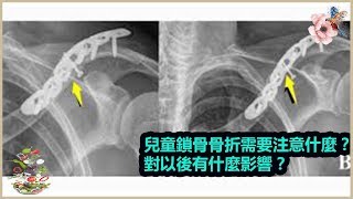 兒童鎖骨骨折需要注意什麼 對以後有什麼影響 分享健康新闻 Youtube 兒童鎖骨骨折需要注意什麼 對以後有什麼影響 分享健康新闻 Youtube