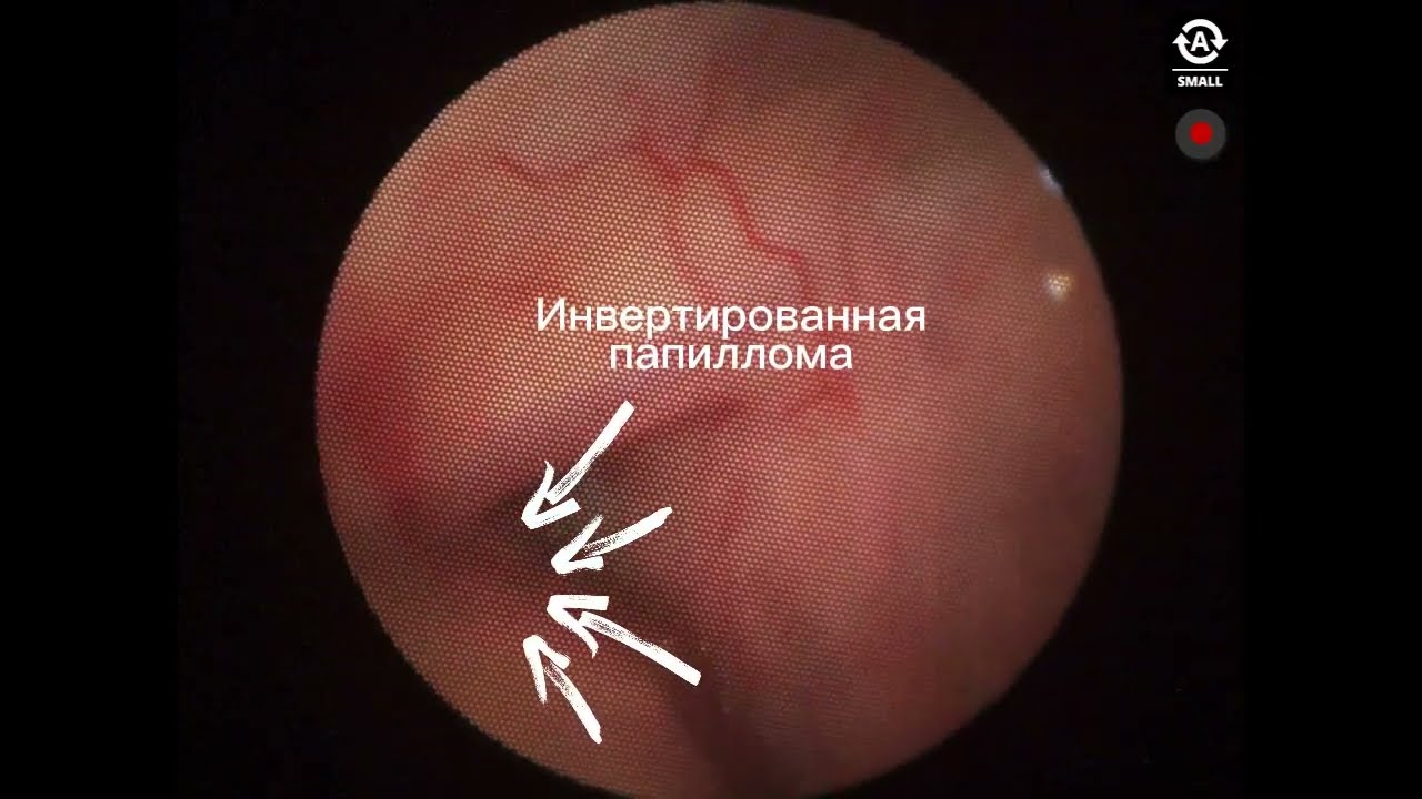 Инвертированная папиллома в носу. Inverted nasal papilloma