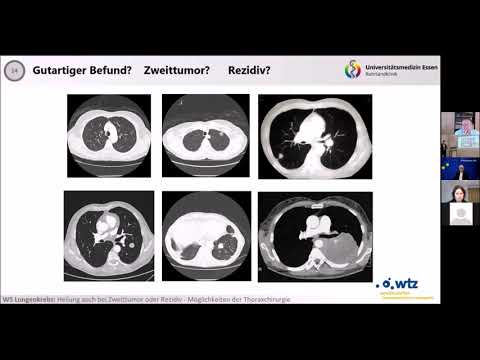 Video: Viele Personen Mit Hohem Risiko Sind Nach US-Richtlinien Nicht Für Das Lungenkrebs-Screening Geeignet