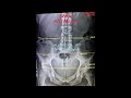 Gonstead Chiropractor Gets Hurt - Before After X-rays, Fake Antalgic X-ray Comparison