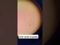 urine crystals.uric acid crystals