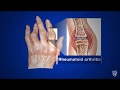 Mayo clinic minute whats rheumatoid arthritis