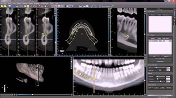 Automatic Nerve Detection. Blue Sky Plan Training Tutorial
