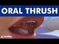 Oral thrush  candidiasis or yeast infection angular cheilitis 