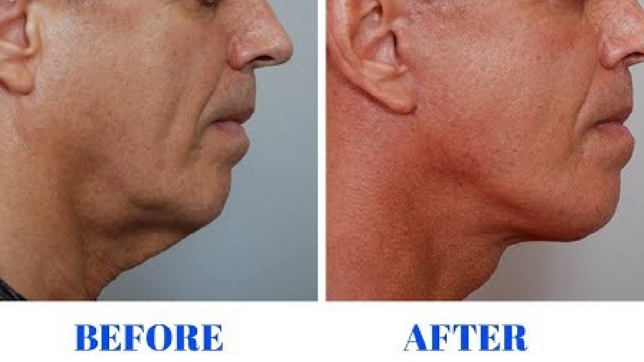 how to get rid of sagging jowls naturally in 1 day - YouTube