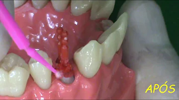 O que é preenchimento de coroa?