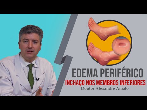 Vídeo: Edema Periférico: O Que é, Sintomas E Causas