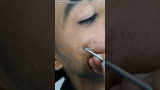 How to remove face blackheads shorts hairstylergulbahar