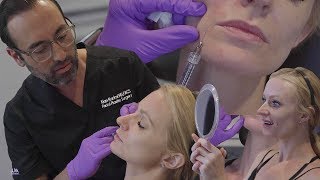 Erasing Smile Lines & Marionette Lines with One Syringe of Revanesse Versa | Dr. Kian Karimi