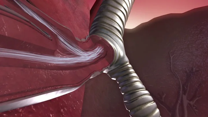 The Mechanics of an Asthma Attack. An Animated Insight