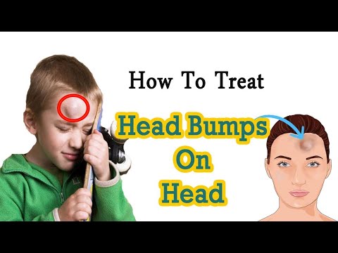 Video: Bump On Forehead: Možné Príčiny A Kedy Vyhľadať Lekársku Pomoc