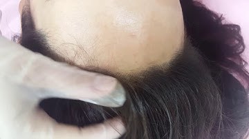 Scalp Hairline Density Restoration Microblading Micropigmentation by El Truchan @ Perfect Definition