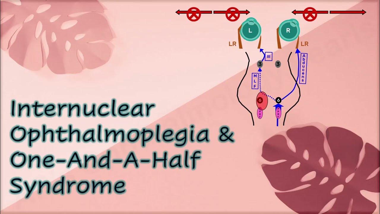 internuclear-ophthalmoplegia-one-and-a-half-syndrome-youtube
