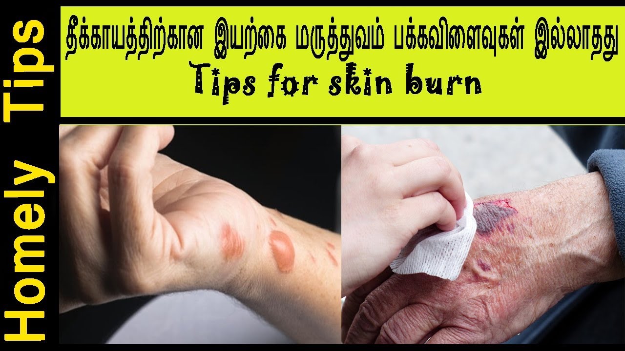 தீக்காயத்திற்கான இயற்கை மருத்துவம் பக்கவிளைவுகள் இல்லாதது Skin Burn