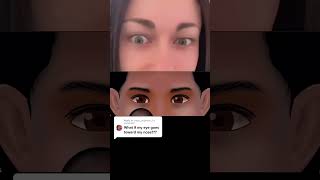 This Is An Esodeviation, An Inward Eye Misalignment