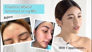 Skin Breakout Recovery - Calista Cuaca