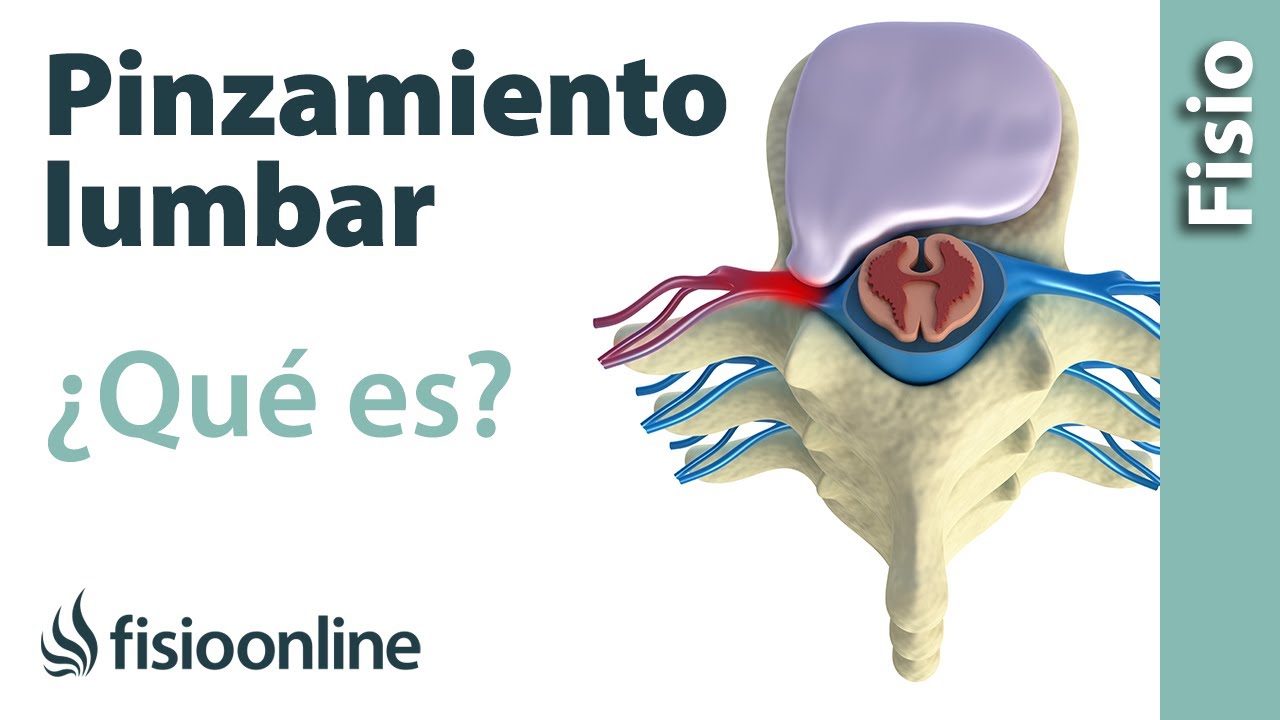 pinzamiento columna vertebral lumbar