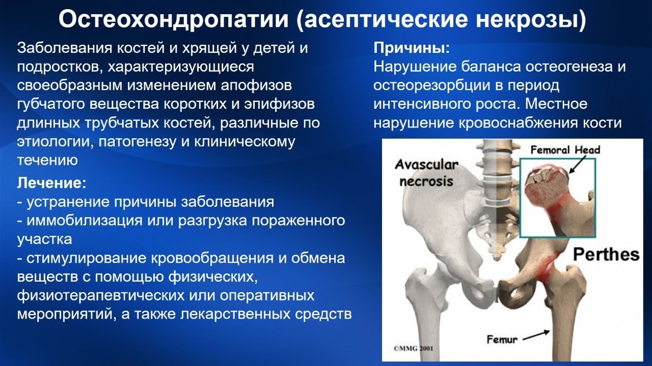 Дистрофические изменения костей. Асептический некроз головки тазобедренного сустава рентген. Некроз кости тазобедренного сустава. Заболевания костно-суставного аппарата.
