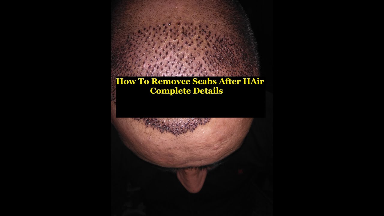 How To Remove Scabs After Hair Transplant Hair Transplant Ky Bad