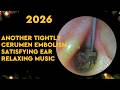 Another Tightly Blocked Cerumen Embolism | Satisfying Ear Wax Removal with Relaxing Music