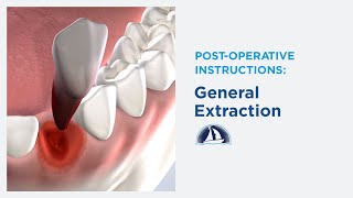 Post-Operative Instructions: General Extractions at Rockwall Oral Surgery