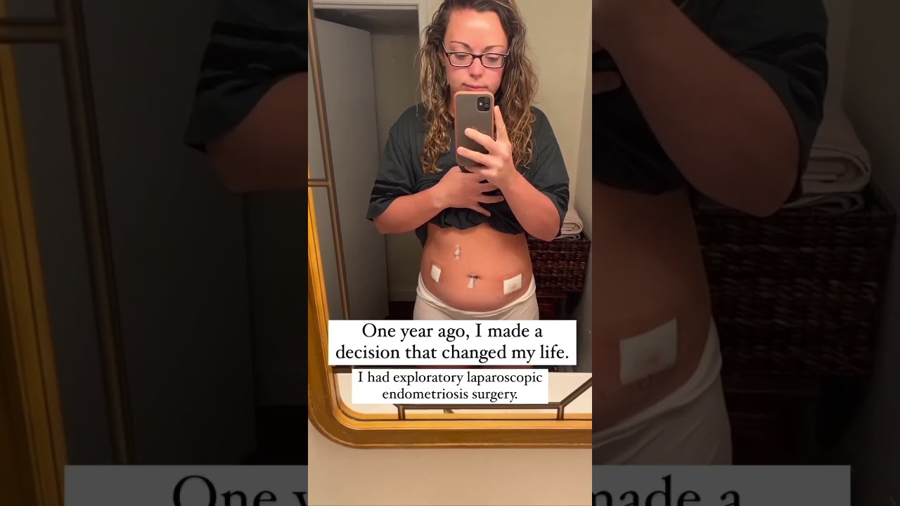 Endometriosis Excision Surgery The Best Decision I Made