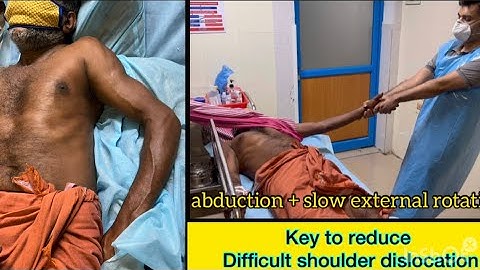 Anterior shoulder dislocation Reduction Technique & Principles | key for reduction |Modified Milch🔥