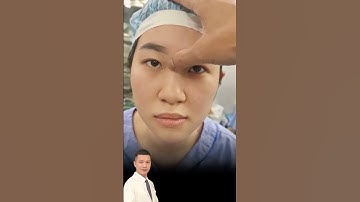 kết quả Cắt mí + mở góc mắt trong |Dr Hùng Thanh