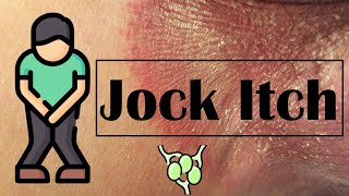 Tenia Cruris Infection (Jock Itch) - Causes, Risk Factors, Signs \& Symptoms, Treatment