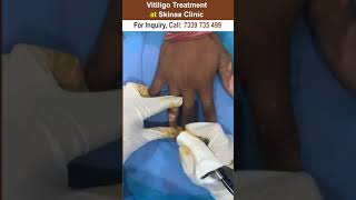 Vitiligo Treatment At Skinaa Clinic 