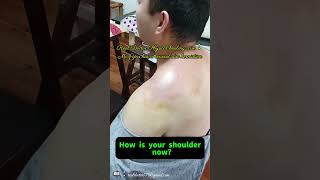 Real Doctor Physical Therapy Case Study: Mr. You's Cervical Disc Herniation — First Treatment