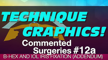 COMMENTED SURGERIES #12a - B-HEX and IOL Iris Fixation (addendum)
