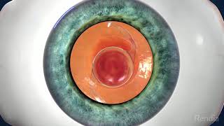 EyeMax Mono AMD IOL Optik Market Ltd Şti.0212 2967646