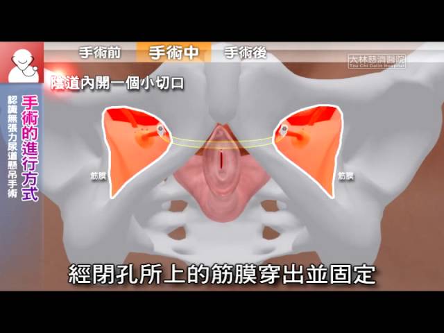 知情同意 認識無張力尿道懸吊手術 國語 Youtube