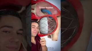 Heart surgery through the groin? - Doctor Explains #doctor #shorts