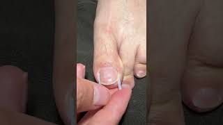 Toe Nail Fixer| Ingrown Toenail Cleaning &amp; Care #ToenailFix #NailCare #FootCare #PedicureClean