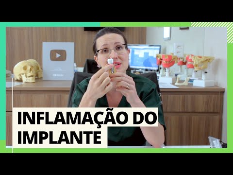 Vídeo: Os Resultados Experimentais Da Implantoplastia Se Correlacionam Com O Crescimento De Fibroblastos In Vitro