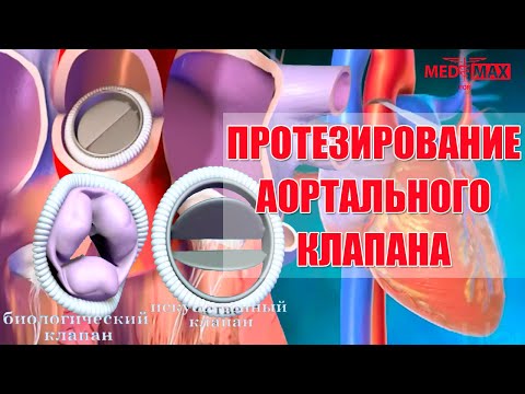 Video: Аллографтын акл реконструкциясы деген эмне?