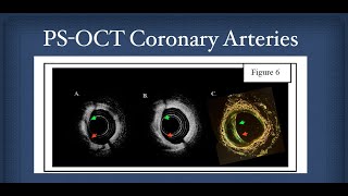 Hypothesis Driven OCT Research: Example of PS-OCT #OCT#Brezinski#Mark#Fujimoto#cardiology#PS-OCT